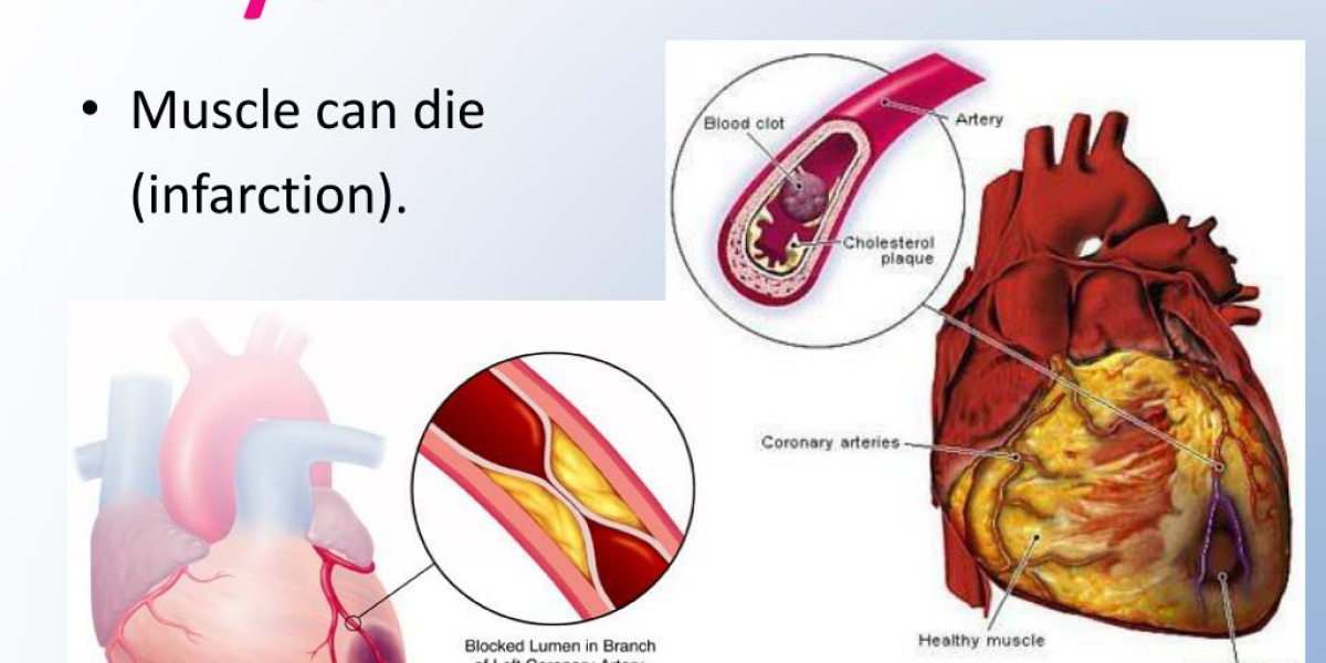 Emerging Trends in Myocardial Infarction Diagnosis