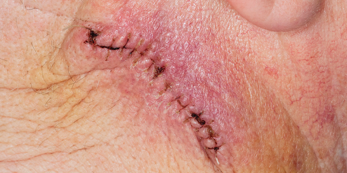 Surgical Site Infections Market Report 2023: Epidemiology, Industry Trends, Size, Share and Forecast to 2033