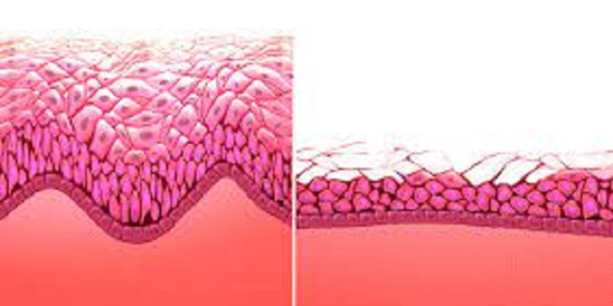 2023, Postmenopausal Vaginal Atrophy Market Research Report Analysis by 2033