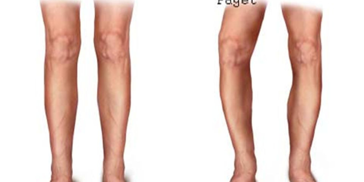 Priced to Succeed: DLI's Expertise in Paget's Disease Market Strategies