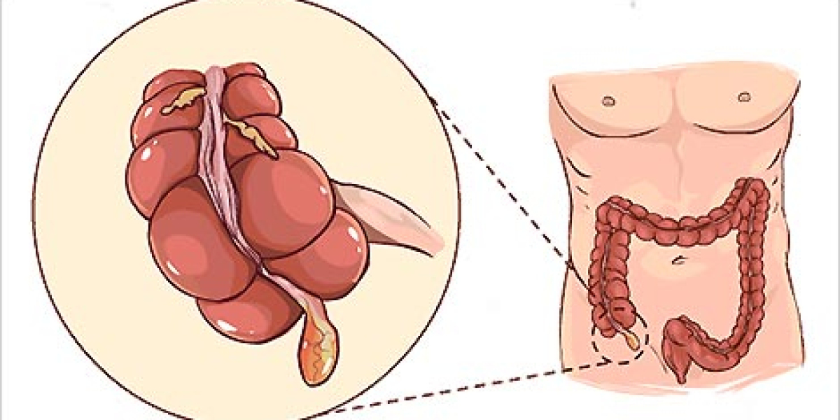 Navigating the Unknown: A Primer on Appendicitis Recognition and Care