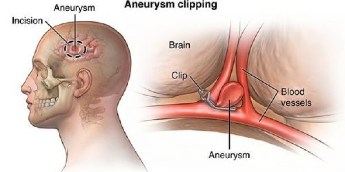Cracking the Code: Brain Aneurysms, Market Strategies, and Regulatory Pathways | DLI