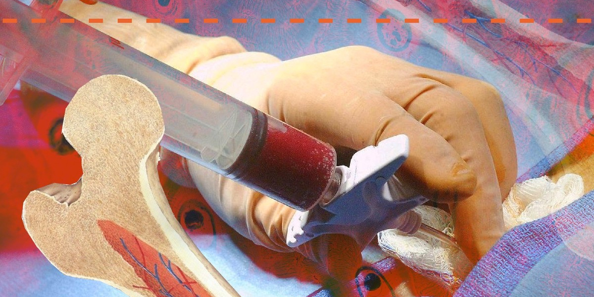 Bone Marrow Transplant Is Estimated To Witness High Growth Owing To Increasing Prevalence Of Cancer