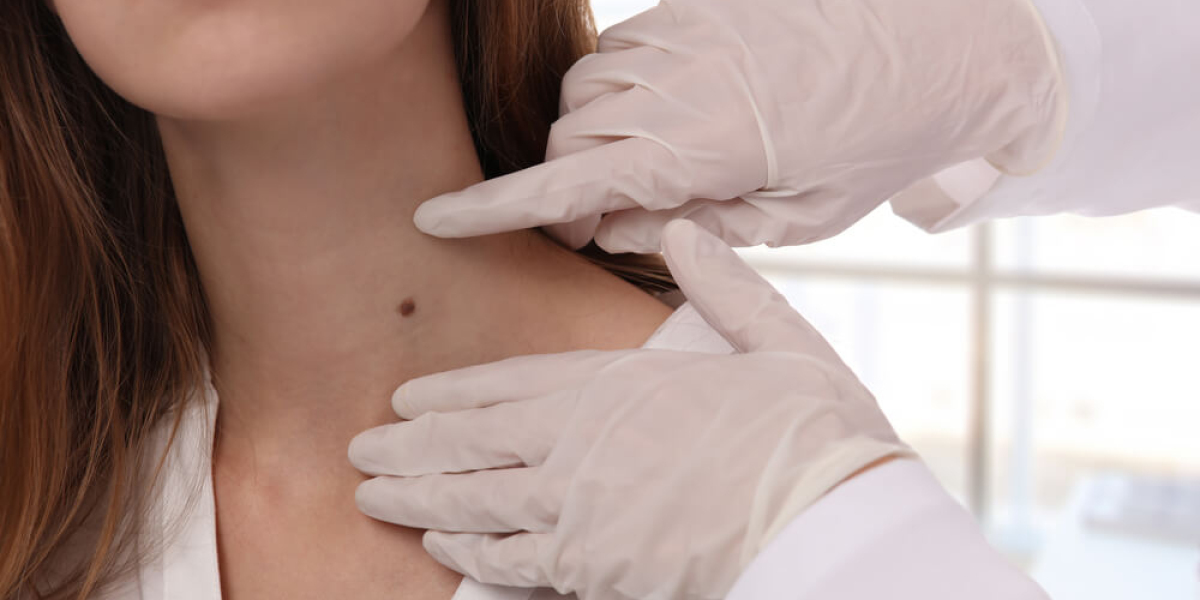 Clean as Teen Reviews: Mole and Skin Tag Serum for People