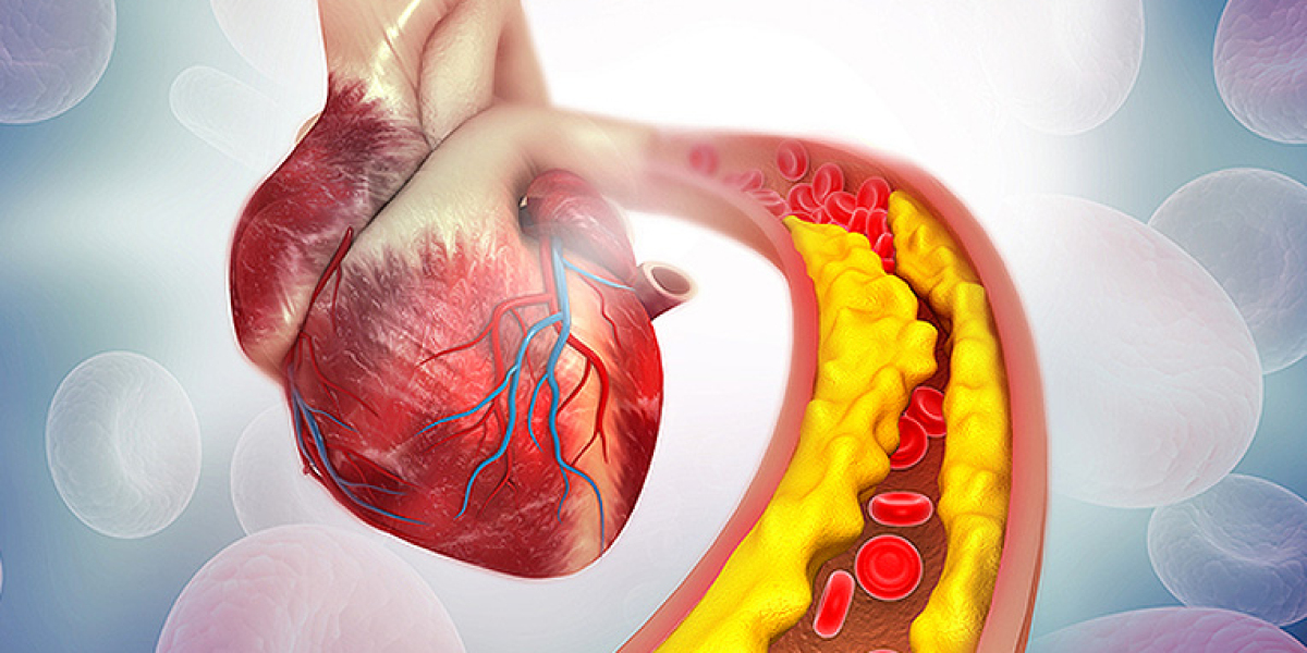 Atherosclerosis Market Size, Opportunity, Overview, Analysis & Trends