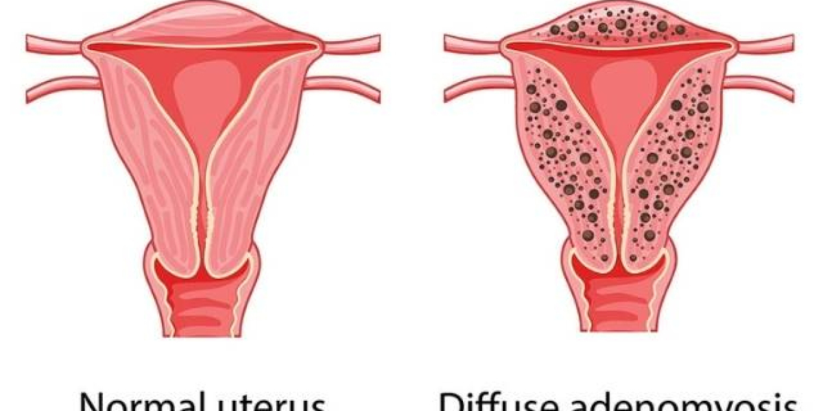 Adenomyosis Demystified: Symptoms and Market Realities