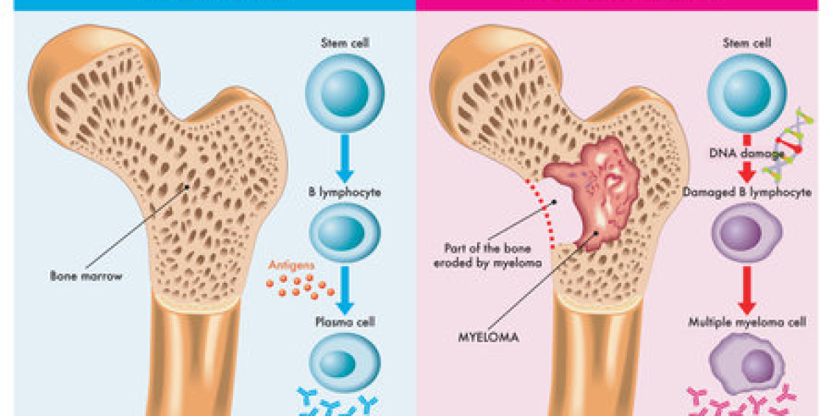 Regulatory Frontier in Myeloma: Strategies for Market Conquest