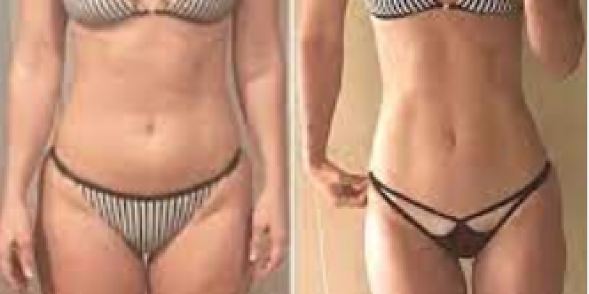 Belly Blast Keto ACV Gummies- Support Your Health With CBD! | Special Offer!