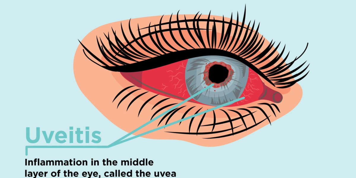 Global Uveitis Treatment Market Size and Forecast to 2030