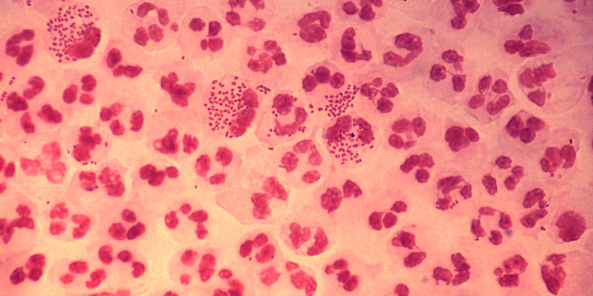 Gonorrhea Market Size : Epidemiology, Industry Trends, Opportunity and Forecast till 2023-2033