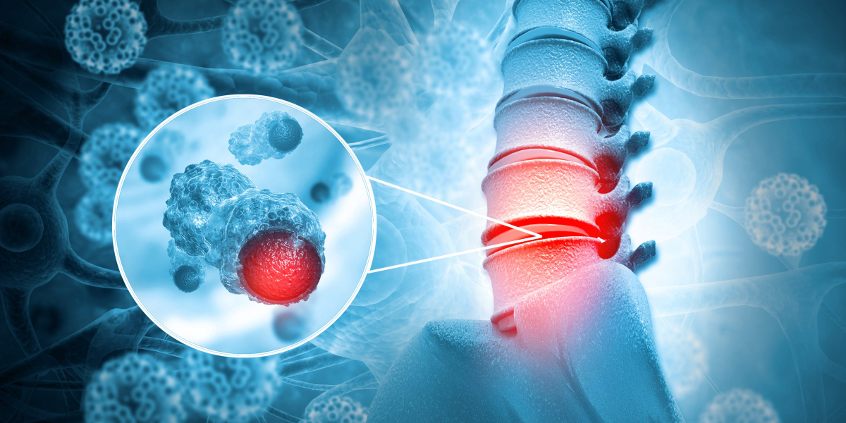 Market Navigation: Bone Cancer Research Analysis and Insights