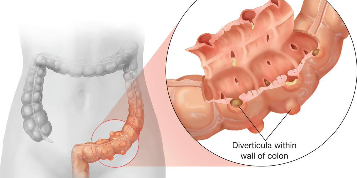 Market Dynamics in Diverticulitis: Research Analysis Revealed | DLI