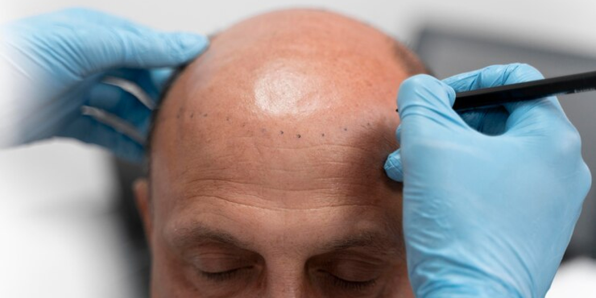 Join the Scalp Micropigmentation Revolution at King's Barber and Beauty