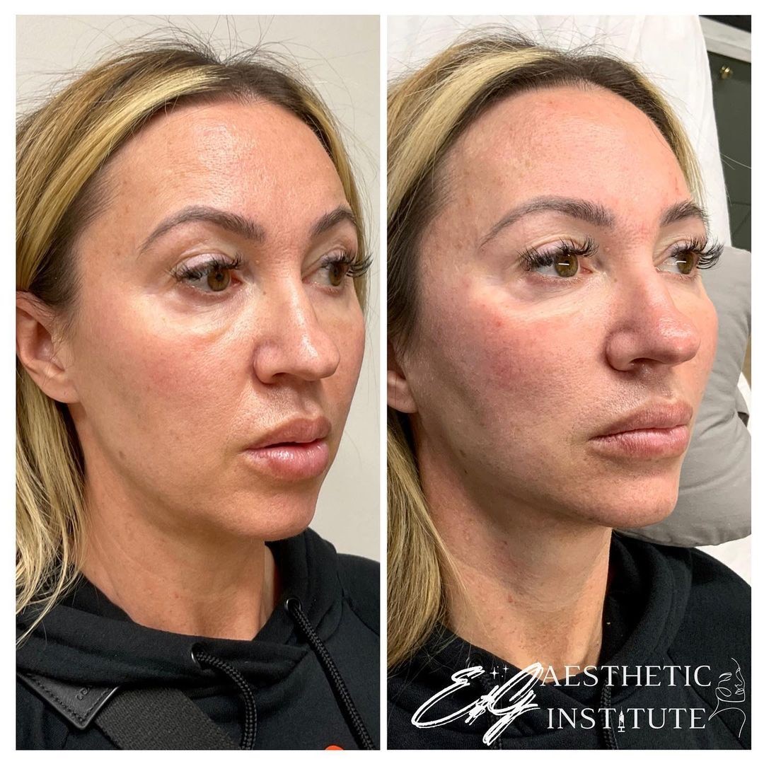 Benefits of Hyaluronic Acid Fillers - Enhancing Facial Rejuvenation