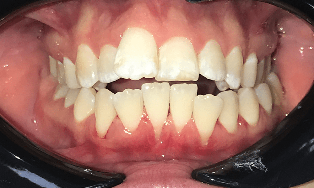 Invisalign before after images - Adelaide Cosmetic Dentistry