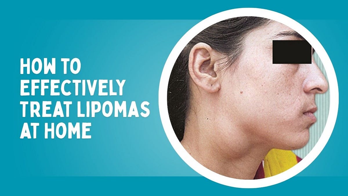 How to Effectively Treat Lipomas at Home | by Lipoma Wand | Jun, 2025 | Medium