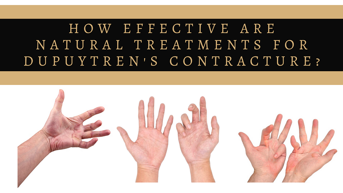 How Effective Are Natural Treatments for Dupuytren’s Contracture?