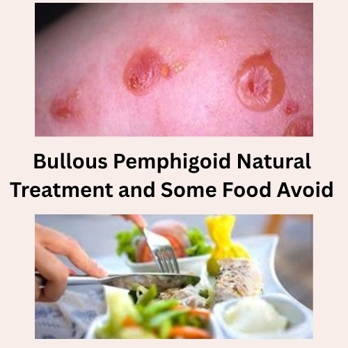 Bullous Pemphigoid Natural Treatment and Some Food Avoid - Herbal Care Products - Blog