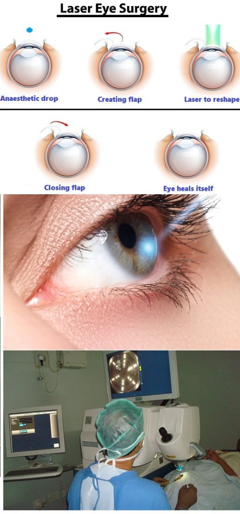 Lasik Laser Eye Surgery Cost | Vedanta Netralya