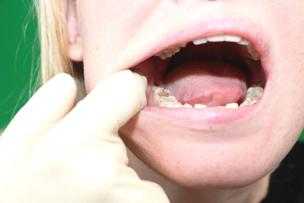 Can Dental Implants Replace Extracted Canines or Wisdom Teeth? - Tumblrblog
