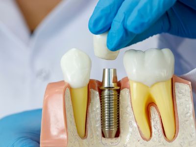Best Dental Hospital in Vizag – Smile Care Dental