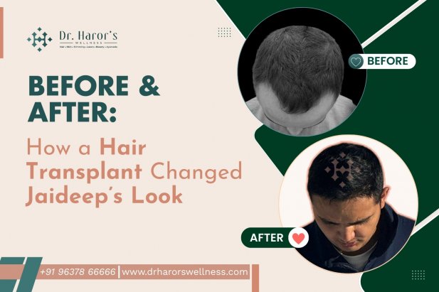 Before & After: How a Hair Transplant Changed Jaideep’s Look Article - ArticleTed -  News and Articles