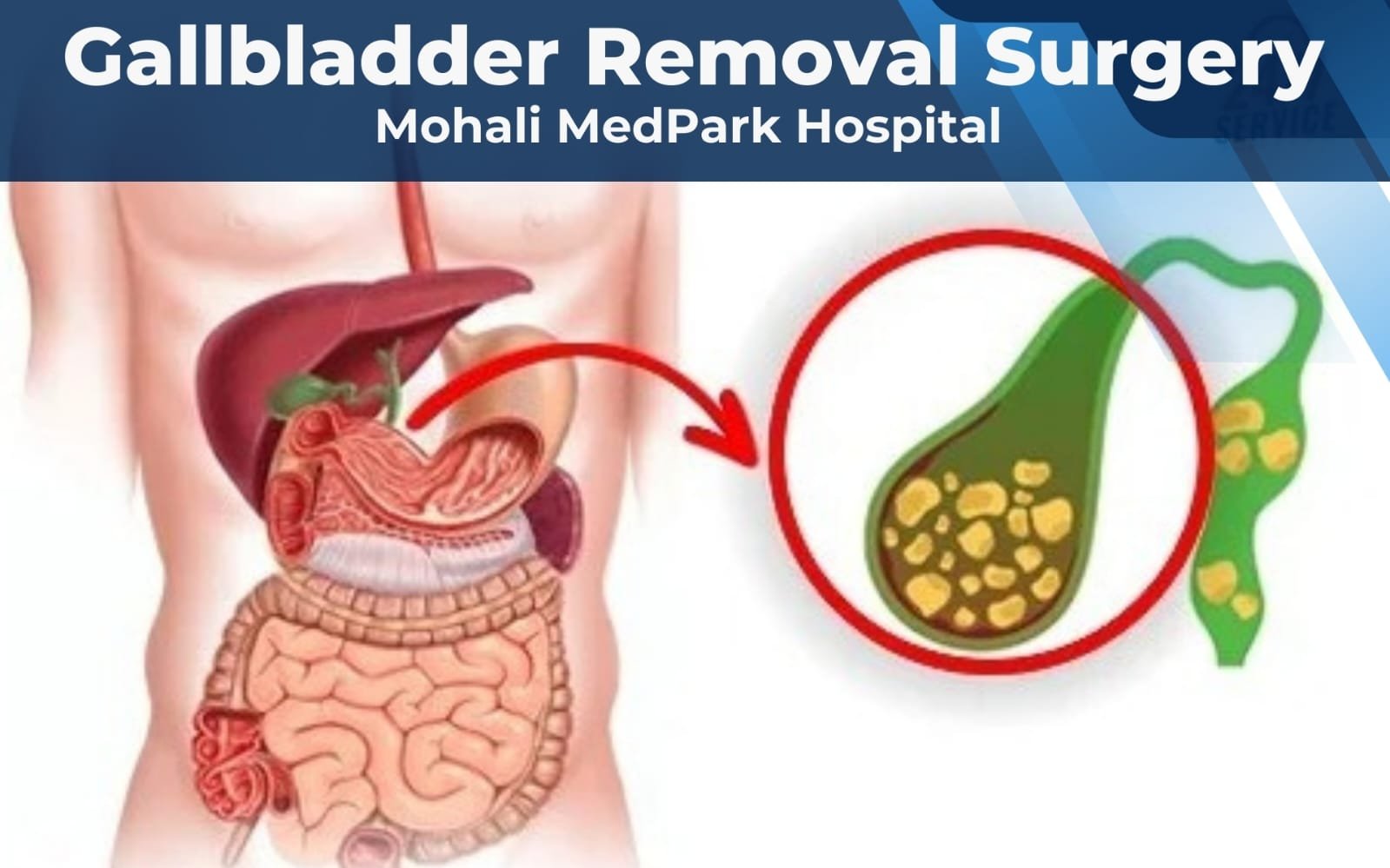 Gallbladder Removal Surgery Mohali - MedPark Hospital