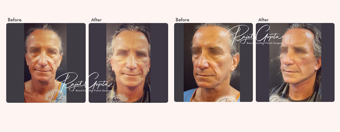 How to Choose the Best Facelift Surgery Clinic in India?