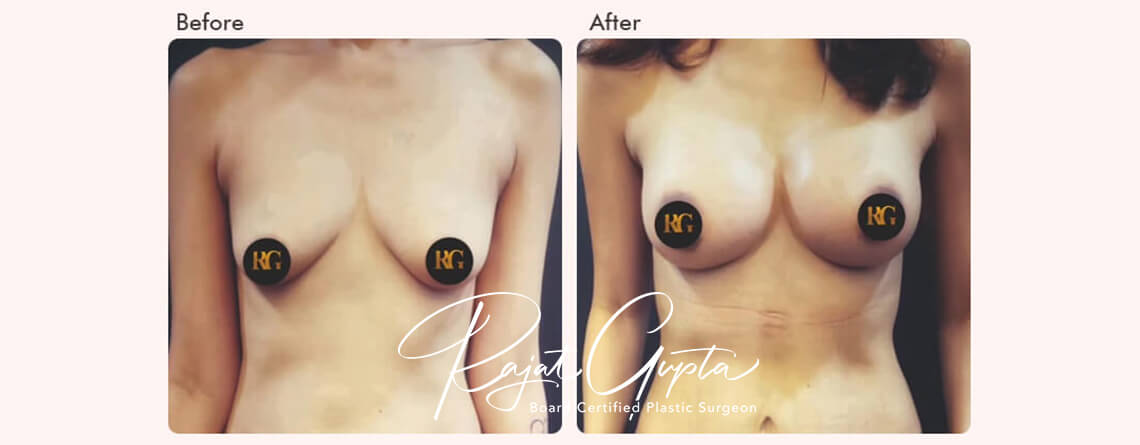 Breast Augmentation Surgery Financing Options in India