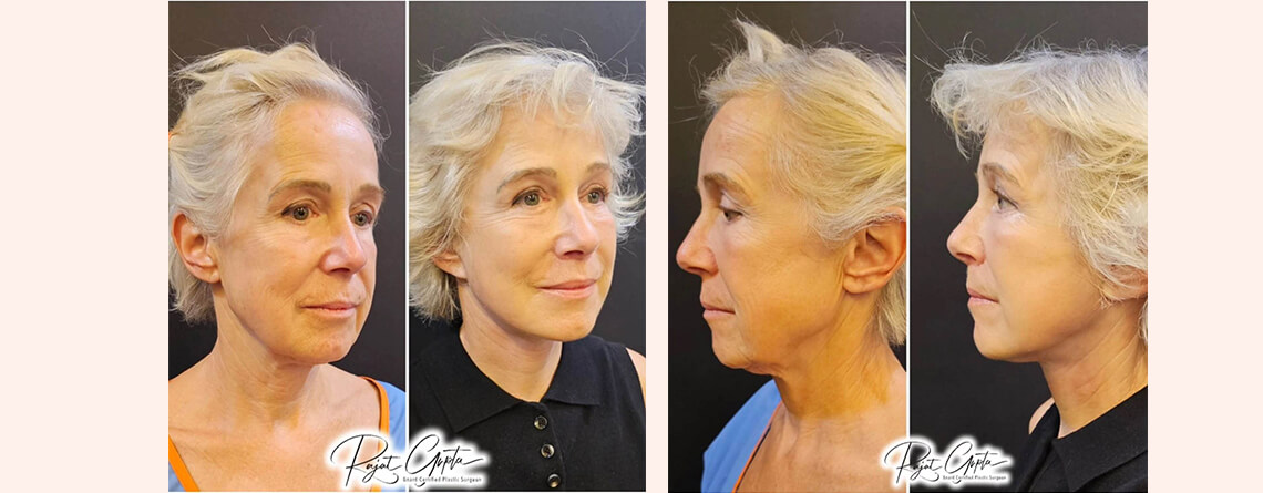 Schedule Facelift Surgery Consultation with Certified Surgeons