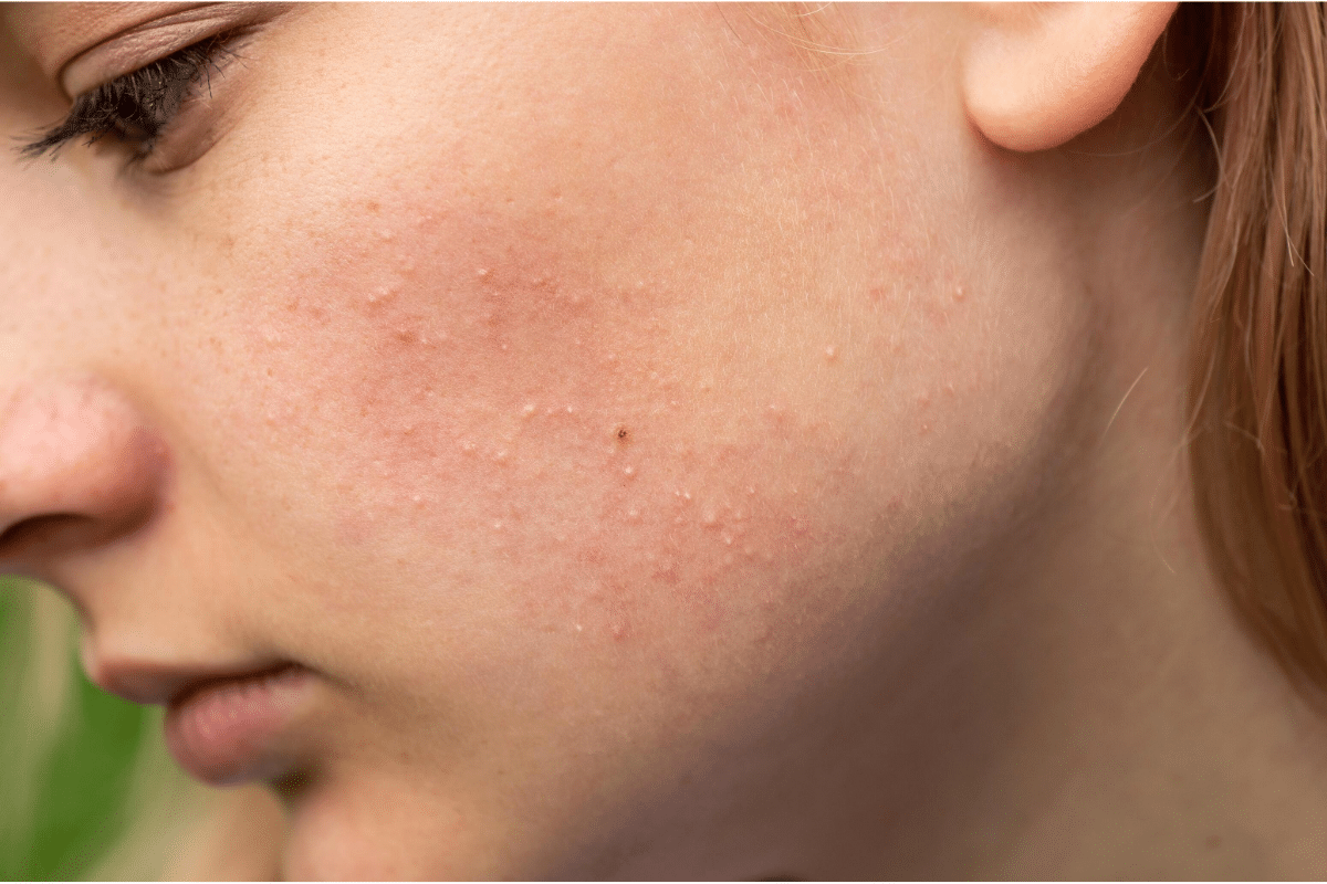 What are these tiny white bumps on my skin?