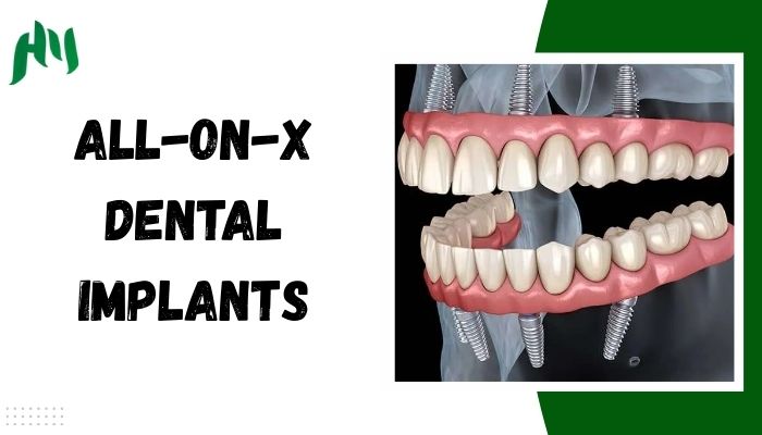 All-on-X Dental Implants: A Full Guide on Benefits, Process & Care