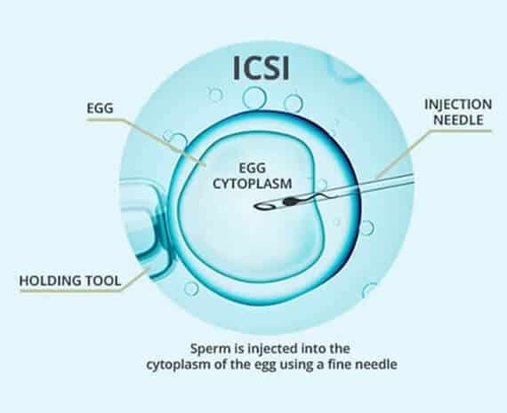 Best ICSI Treatment in Delhi | Top ICSI Clinic | Excel IVF