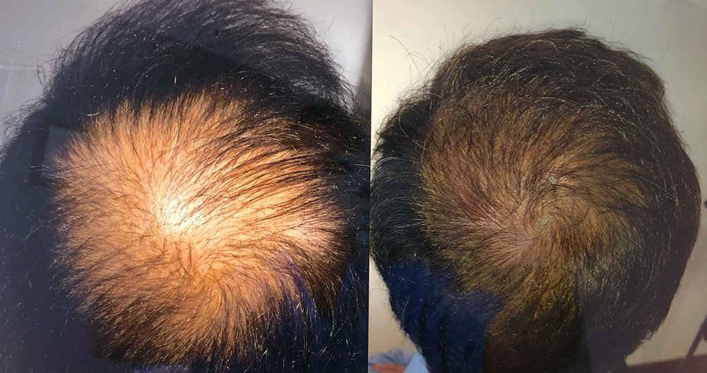 clinica injerto capilar barcelona