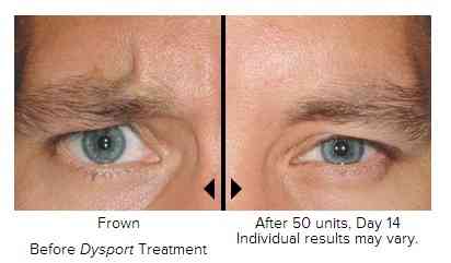 Botox & Dysport Lehigh Valley | Azani Medical Spa